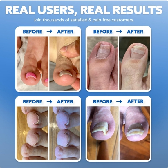 Curve Correct Ingrown Toenail Corrector Kit - Picture 3 of 9